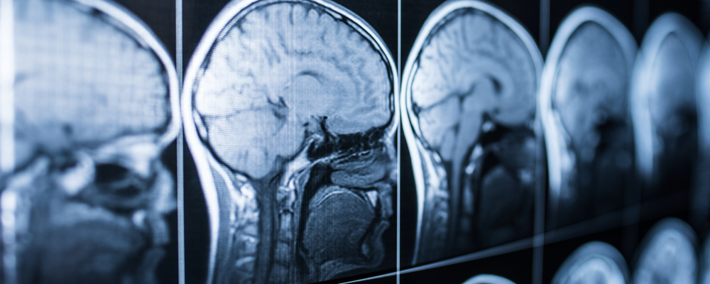 San Antonio Brain Injury Attorneys